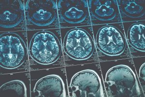 A SEQUENCE OF BRAIN SCANS TO INDICATE CANCER MISDIAGNOSIS
